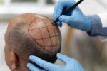 Hair Transplant By Sarin Skin Services Supply