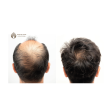 Hair Transplant By Sarin Skin Services Supply