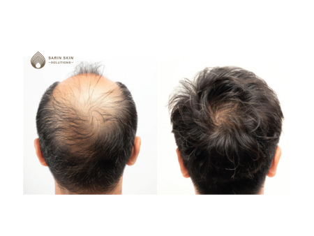 Hair Transplant By Sarin Skin Services Supply