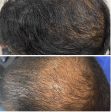 Hair Transplant By Sarin Skin Services Supply