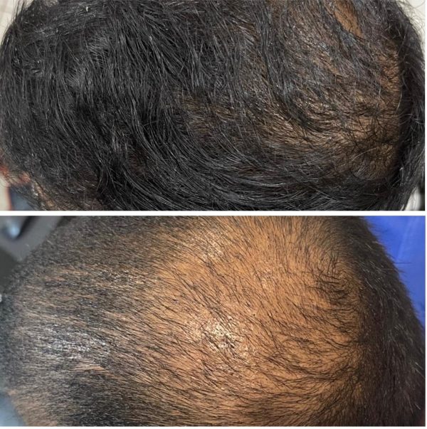 Hair Transplant By Sarin Skin Services Supply